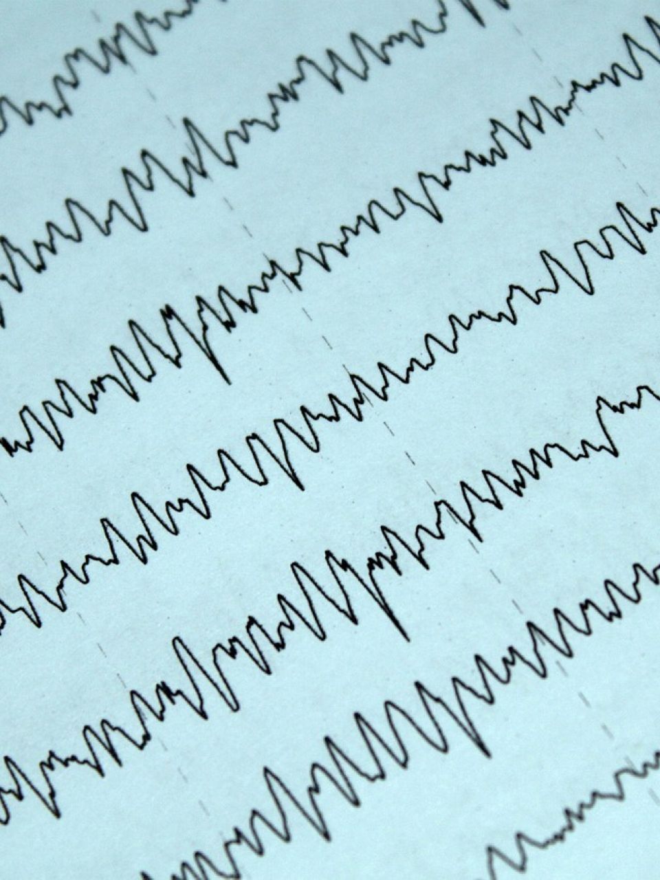 Darstellung der Wellen einer Elektroenzephalographie – elektrische Hirnwellenmessung