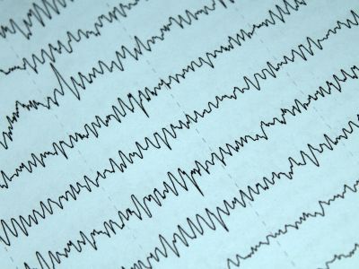 Darstellung der Wellen einer Elektroenzephalographie – elektrische Hirnwellenmessung